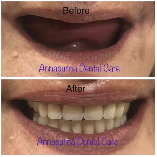 BPS Dentures & Cast Partial Dentures