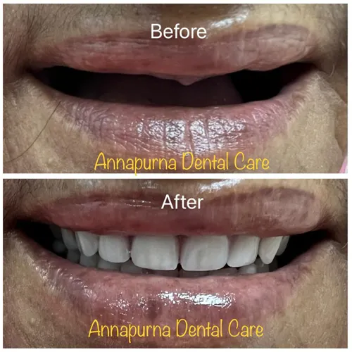 BPS Denture Case 33
