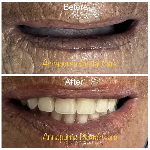 BPS Denture Case 34