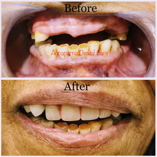 Cast Partial Denture Case 12
