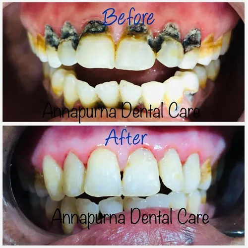 Cervical Restoration (Tooth Abrasion Treatment)