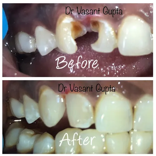 Composite Build Up & Fractured Tooth Repair