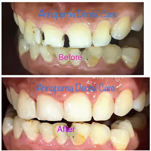 Composite Build Up Case 11