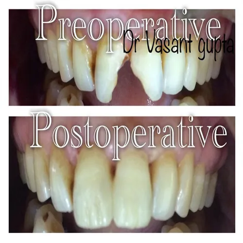 Composite Build Up Case 38