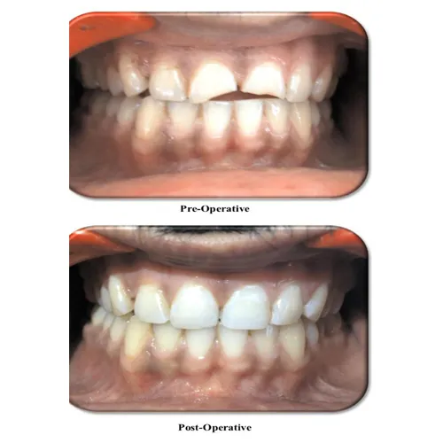 Composite Build Up Case 39