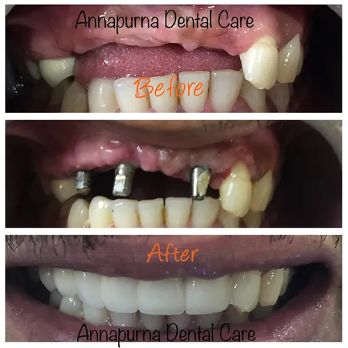 Single Immediate Implant Case 9