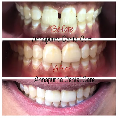 Diastema Closure (Midline Gap Treatment)