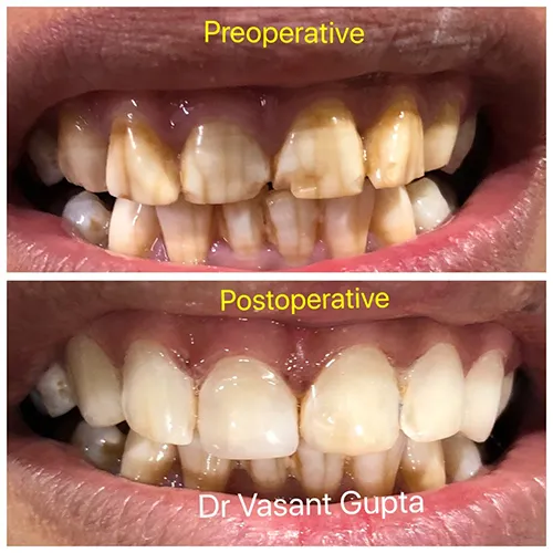 Direct Composite Veneers