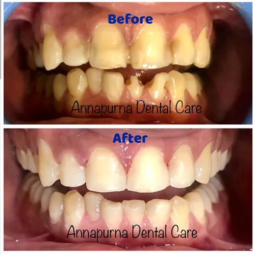 Direct Composite Veneers Case 15