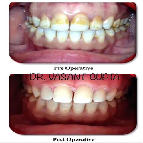 Direct Composite Veneers Case 28