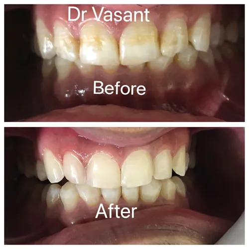 Direct Composite Veneers Case 4