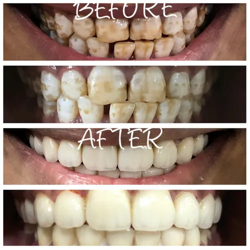 Fluorosis Treatment & Aesthetic Masking