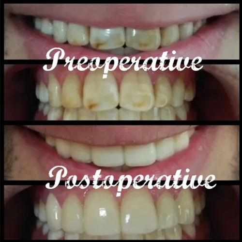 Moderate Fluorosis Restoration Case 30