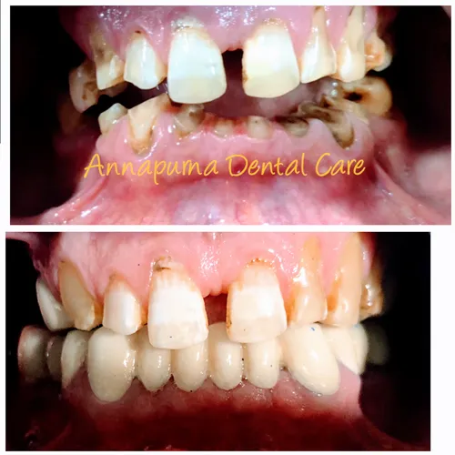 Full Mouth Rehabilitation