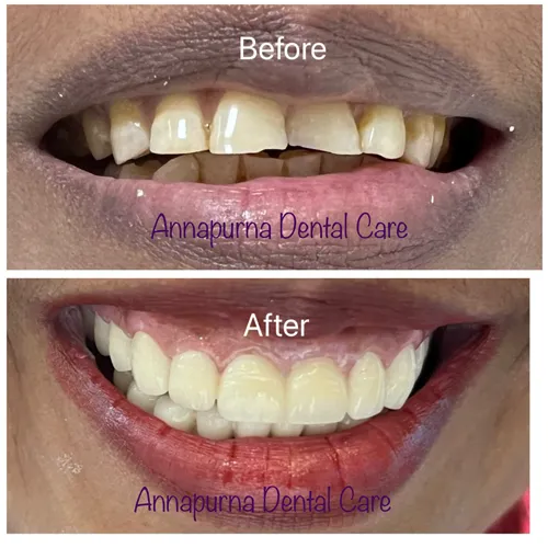 Cercon Crowns Full Mouth Case 19