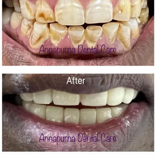 Zirconia Reconstruction Case 22
