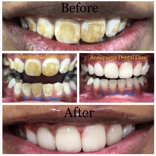 Indirect Veneers Case 14