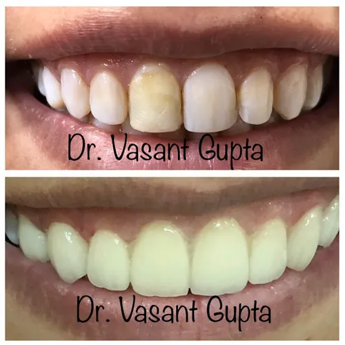 Indirect Veneers (Porcelain & Ceramic)