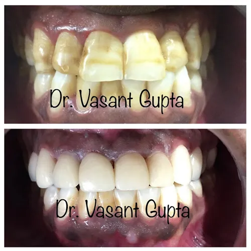 Indirect Veneers Case 3