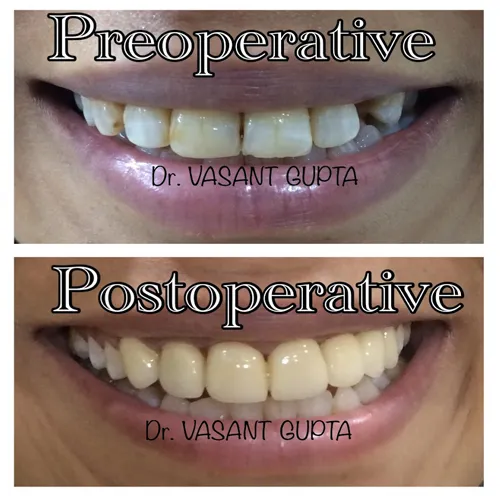 Indirect Veneers Case 6