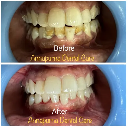 Laser Periodontal Decontamination