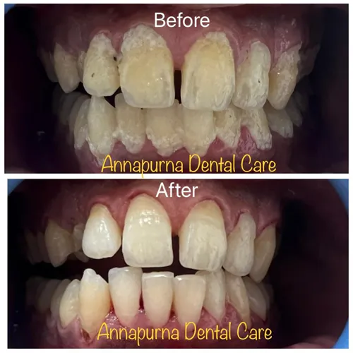 Aesthetic Gum Depigmentation