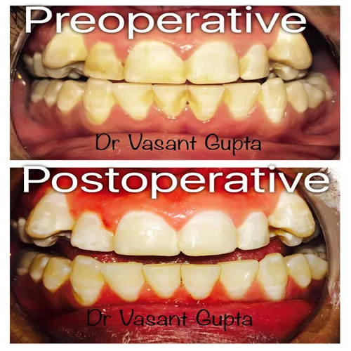 Laser Scaling & Periodontal Therapy