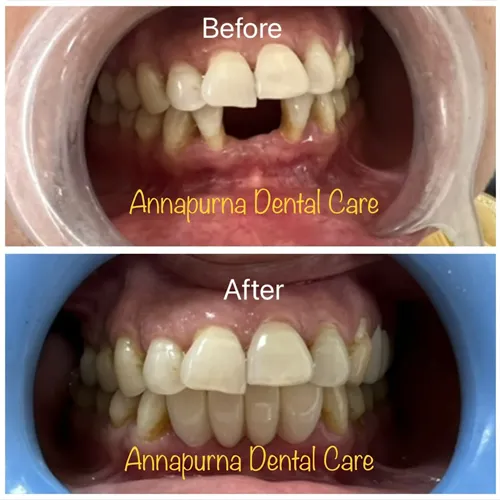 Zirconia Crowns & Ceramic Bridges