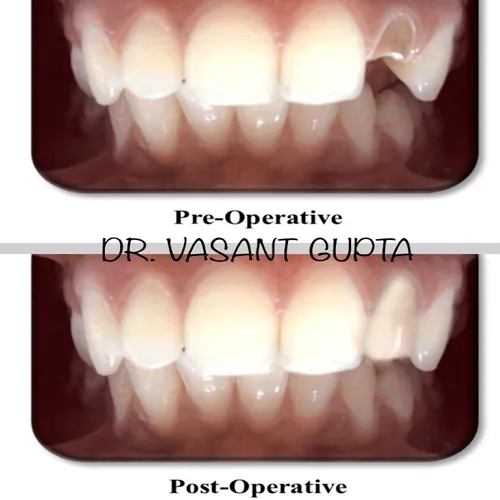 Post and Core Restoration