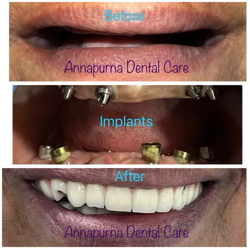 Full Mouth Implants Case 20