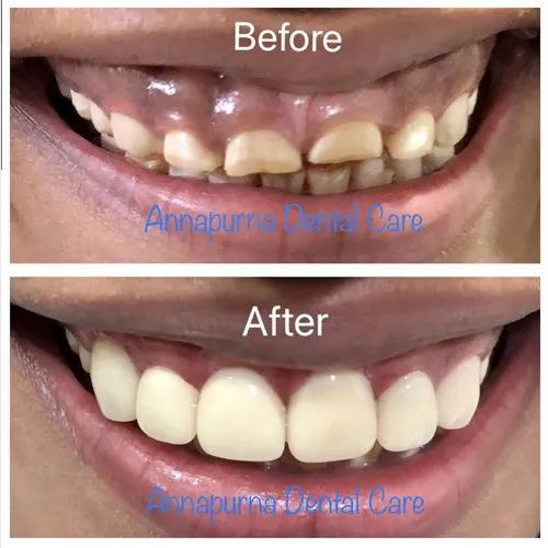 Digital Smile Designing & Makeover