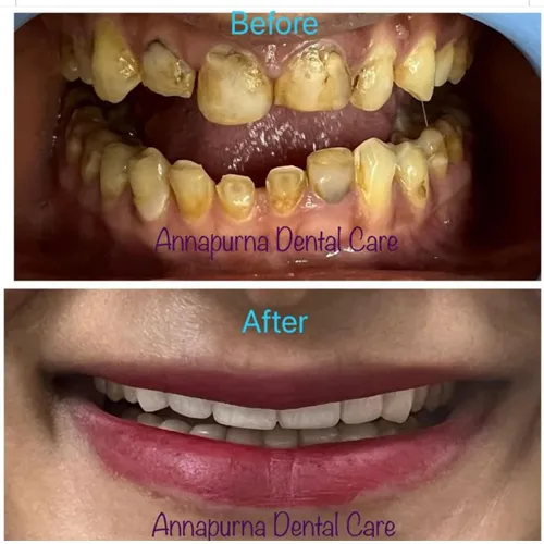 Smile Design Zirconia Crowns Case 21
