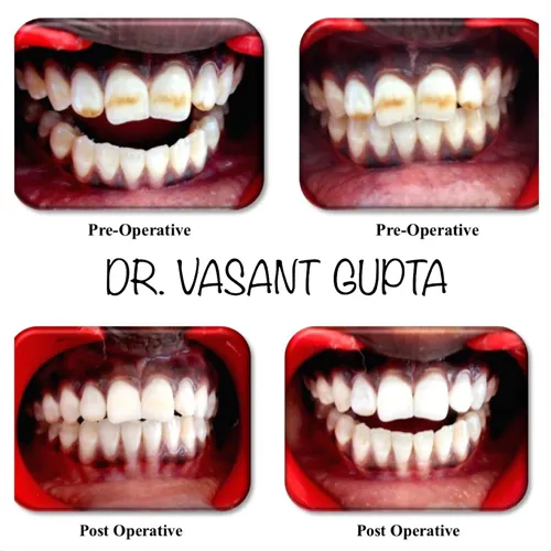 Tooth Bleaching & Laser Whitening