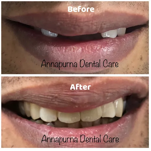 Zirconia Crown on Implant Case 18