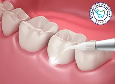 Advanced Laser Dentistry