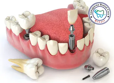 Dental Implants & Immediate Teeth