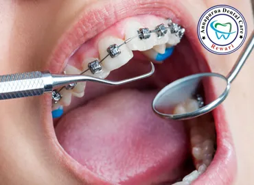 Orthodontic Braces & Clear Aligners
