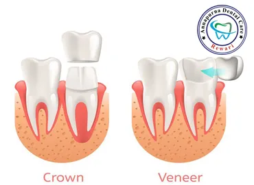 Porcelain Veneers & Ceramic Crowns